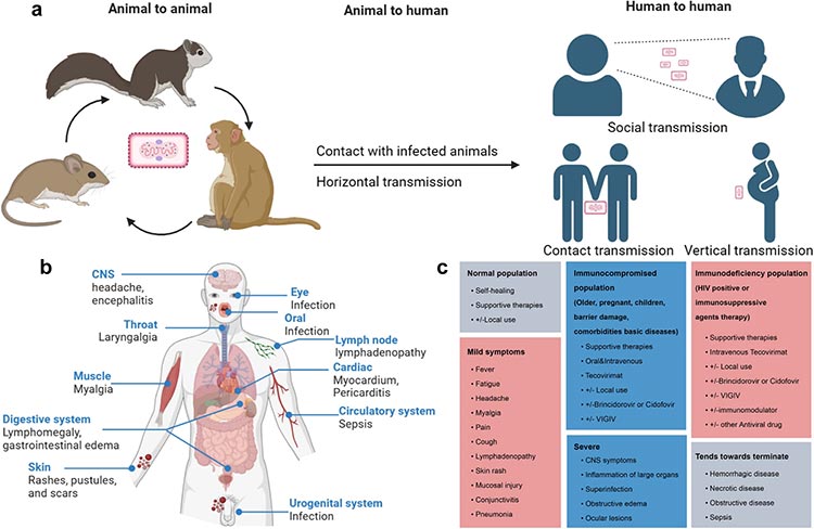 猴痘的流行病学特征、发病机制、临床诊断和治疗