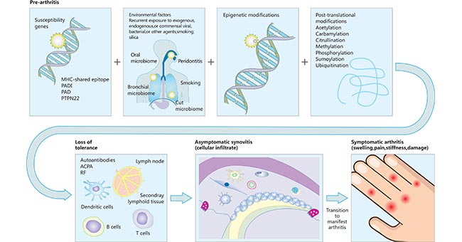 类风湿性关节炎的发病途径